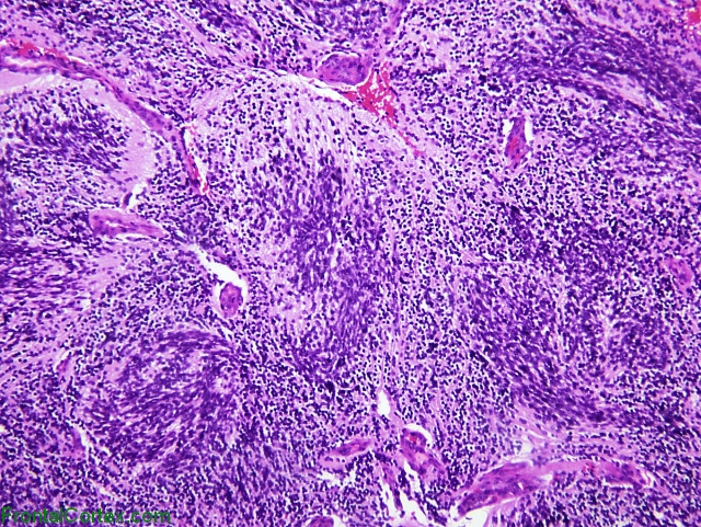 Medulloblastoma with extensive nodularity, H&E stain x 200